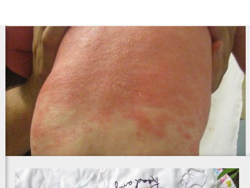 Before Eczema Treatment
