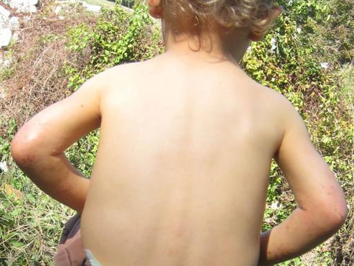 After Eczema treatment